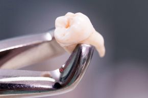 Удаление зубов у взрослых